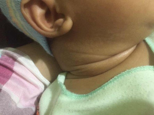 Totol putih d leher bayi usia 2 bln