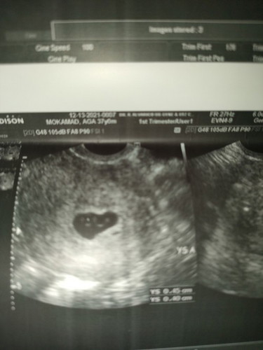 9weeks and 3days palang bumigay na sila.twin sana at nawalan ng heartbeat in 9weeks😭