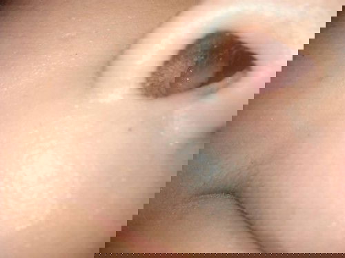 ก้อนใสๆอยู่ในรูจมูก