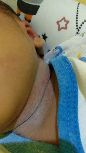 Cara menghilangkan biang keringat