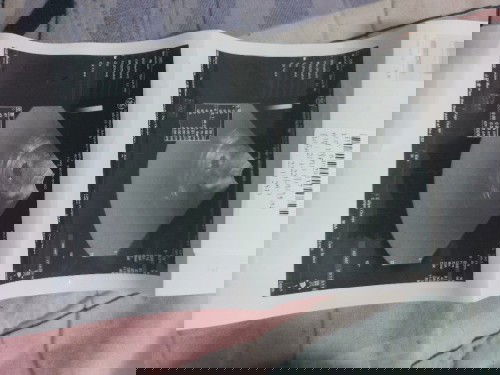 อัลตร้าซาวด์แล้วผลที่ได้คือหมอบอกว่า มีถุงการตั้งครรภ์แต่ยังไม่เห็นหัวใจเด็ก อายุประมาณเท่าไรคะ