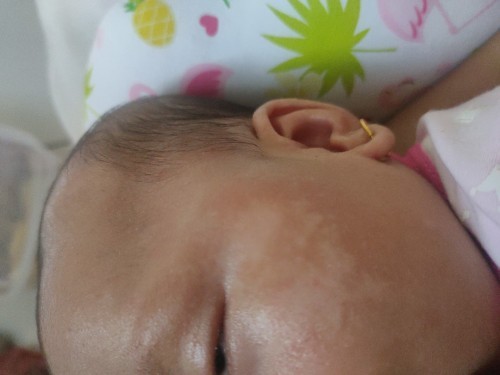 Bercak putih pada wajah bayi