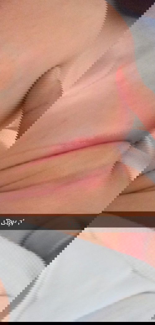 Rashes sa leeg ng baby, ano ang pwede maigamot dito?