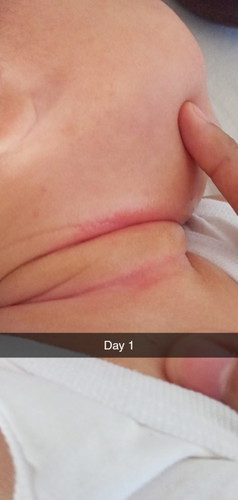 Rashes sa leeg ng baby, ano ang pwede maigamot dito?