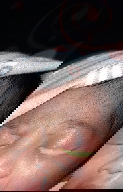 Mata bayi baru lahir belekan