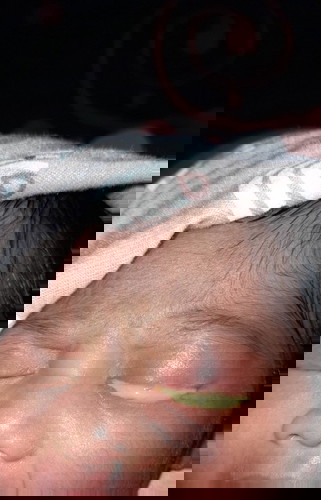 Mata bayi baru lahir belekan