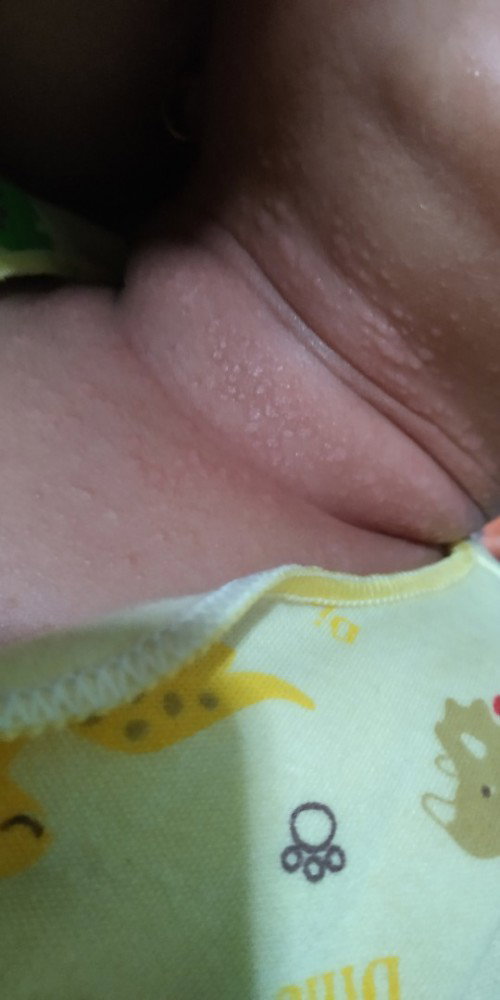 leher bayi bruntusan