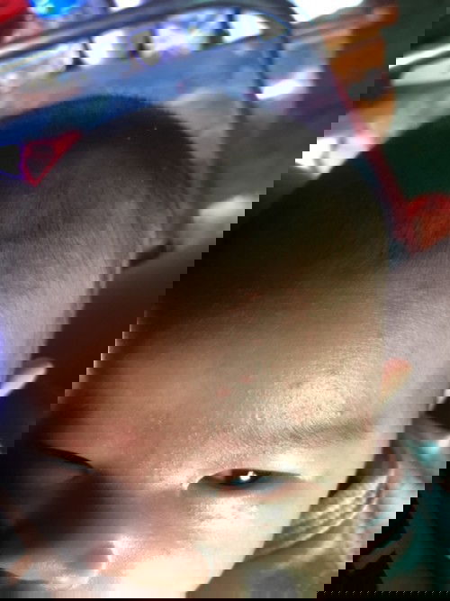 ลูกเป็นผื่นแดงที่หน้าและหัว