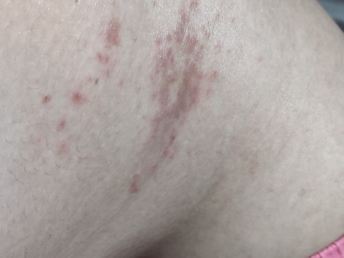 ผื่นอะไรคะขึ้นตามสีข้างสะโพกทั้งสองข้างเลยค่ะ คันมากๆๆๆ แม่บอกไม่ให้เกาเพราะมันคือรอยแตกลาย