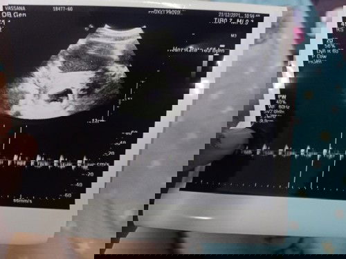 ตรวจเจอซีสต์ตอนตั้งครรภ์