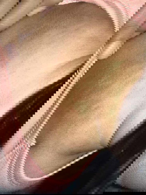 kulit kering memerah