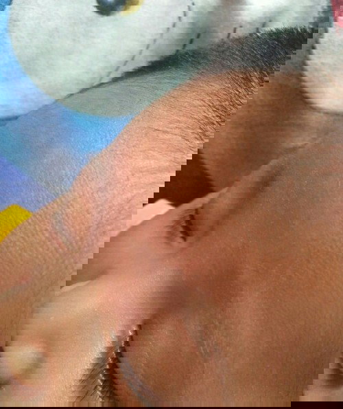 bun jidat anaku aga ada putih nya kira2 apa solusinya ya bun biar cepet ngilangin nya.😊