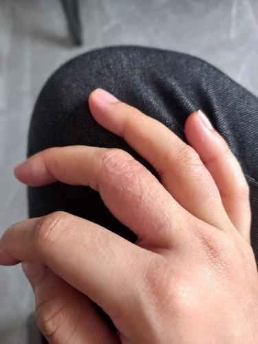 Eczema sa buntis