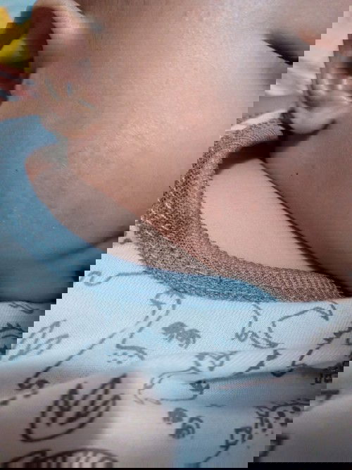 RASHES SA FACE NI LO