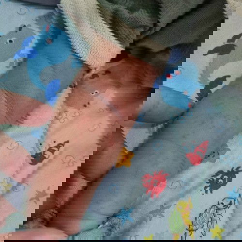 Bun, ini biang keringat atau alergi ya?