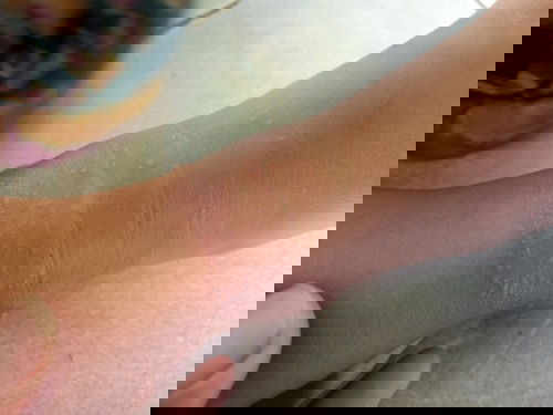 Bintik² di bagian kaki