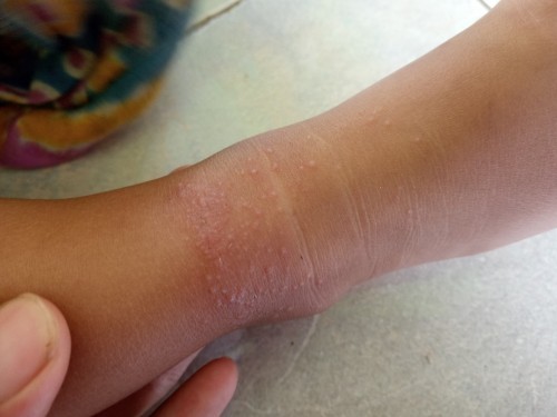 Bintik² di bagian kaki