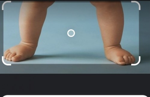 Flat feet bayi 15 bulan