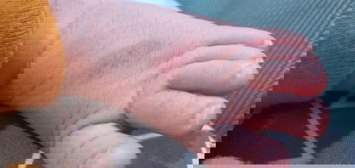 Merah seperti memar pada kulit bayi tidak hilang selama beberapa minggu