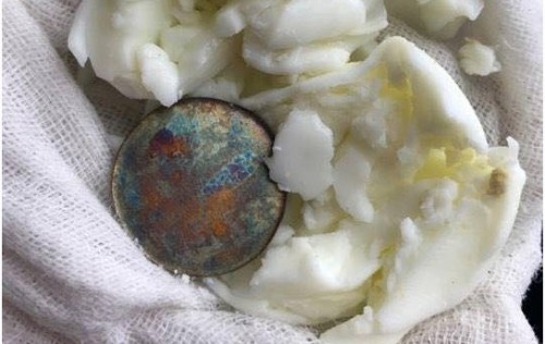 Đang cho con bú cạo gió được không?