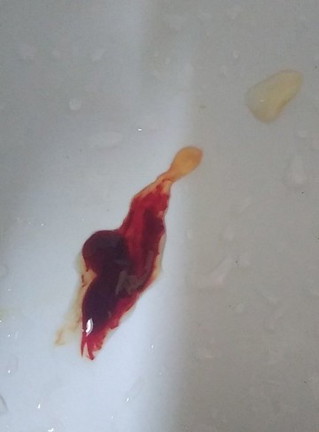 เลือดกำเดาไหล