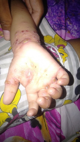 Masalah kulit pada anak