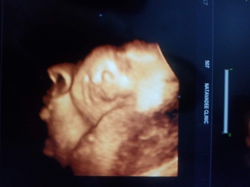 แม่ๆที่คลอดน้องเดือนมีนาคมเป็นกันบ้างคะ