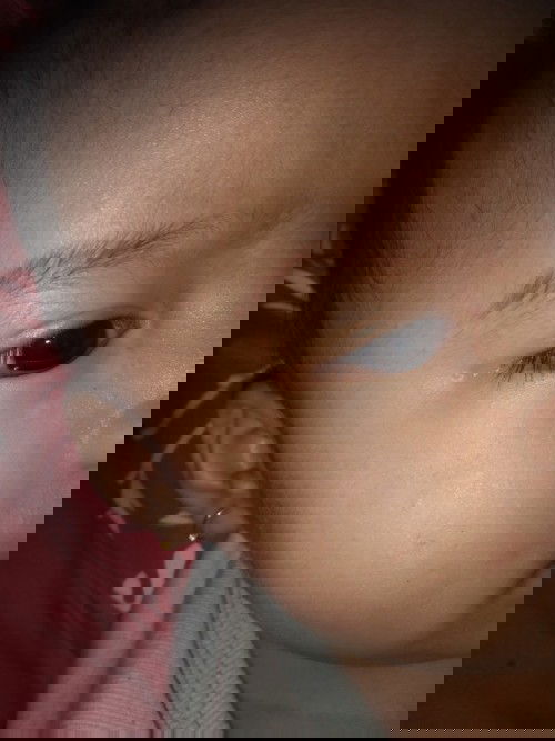 Bintik putih pada bayi 5 bulan