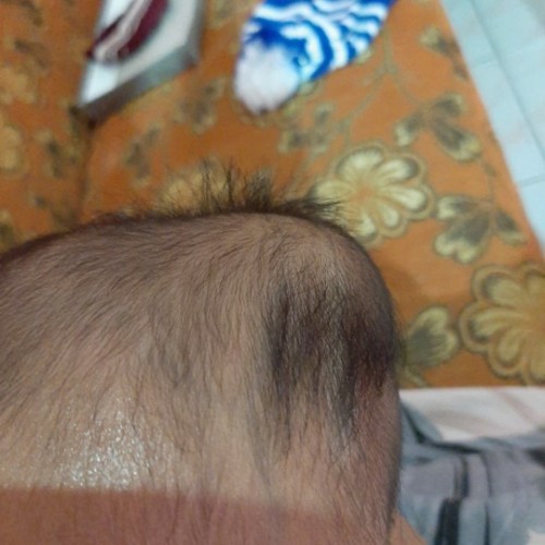 Benjolan di kepala bayi bagian atas kiri