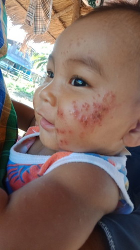 มีผื่นน้ำเหลืองไหล