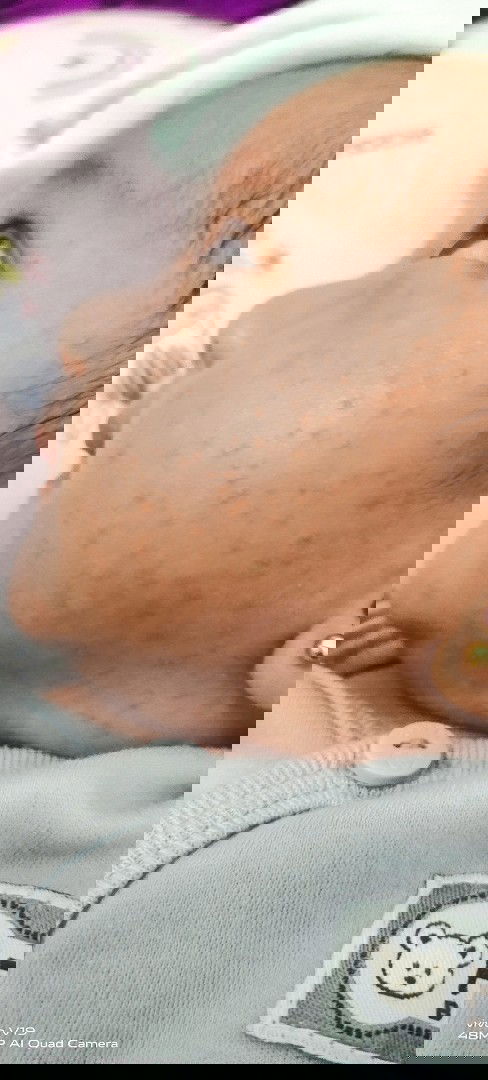 bintik merah pada bayi