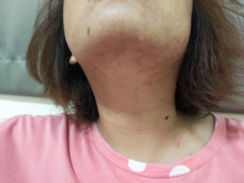 แม่ๆมีใครสิวเห่อบ้างมั้ยคะ 21วีค+2