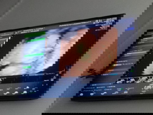 ตรวจพบไตโต1ข้างค่ะหมอบอกไม่ต้องกังวน เราก็แอบเครียดอยู่ค่ะ ตอนนี้น้องได้23วีคค่ะ