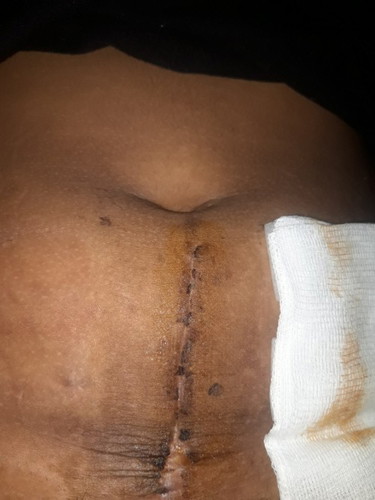 Csection first time