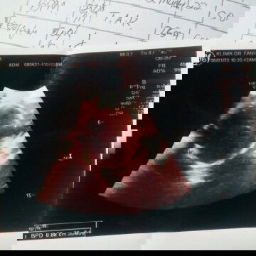 hasil usg dan periksa ke bidan