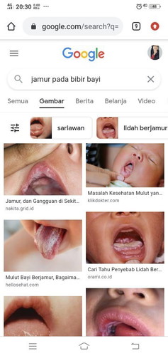 Jamur pada bibir bayi