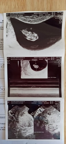 I am 10weeks and about to undergo pre-employment physical exam? Malalaman ba nila sa Urinalysis yun?