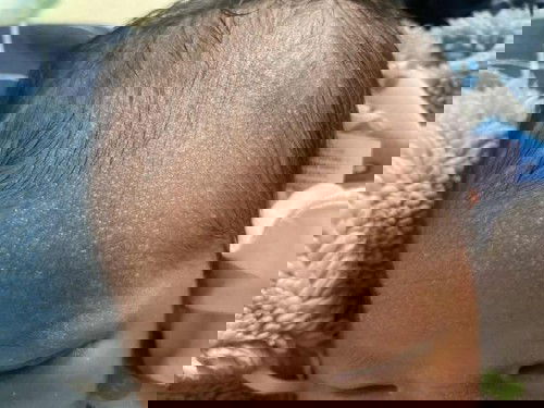 ผื่นทารกเเรกเกิด