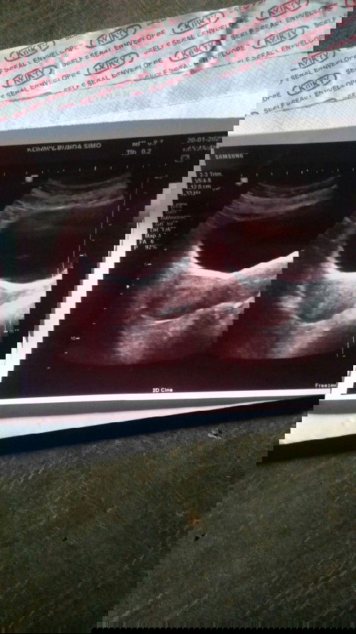 Keguguran disemester 1