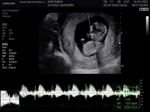 Journey for 12 week baby