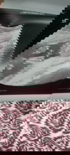 Scan 20 weeks 2 hari..npk ke jantina begini 😅🤣Dokter scan tadi