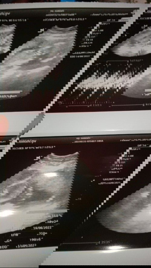 Hasil USG 19 minggu
