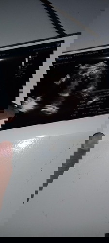 HPL mundur karena BB janin turun