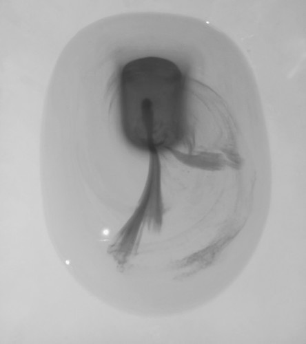 pagbabawas ng dugo sa matress ko