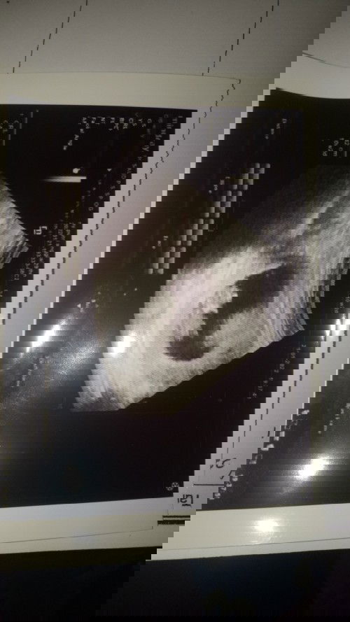 alhamdulillah kehamilan ank k 2 dg UK 10w2d