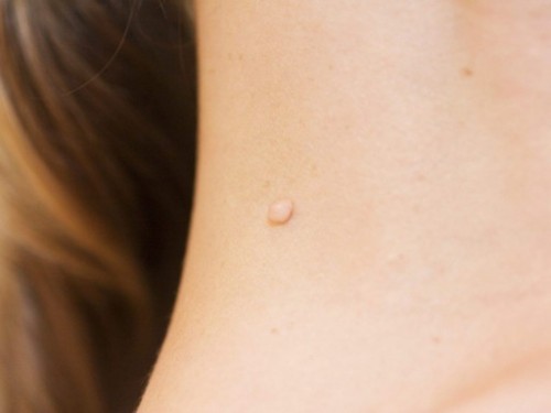 Skin tags problem