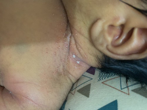 Iritasi bukan si?