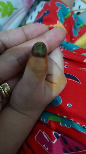 Patay na kuko ni Baby π