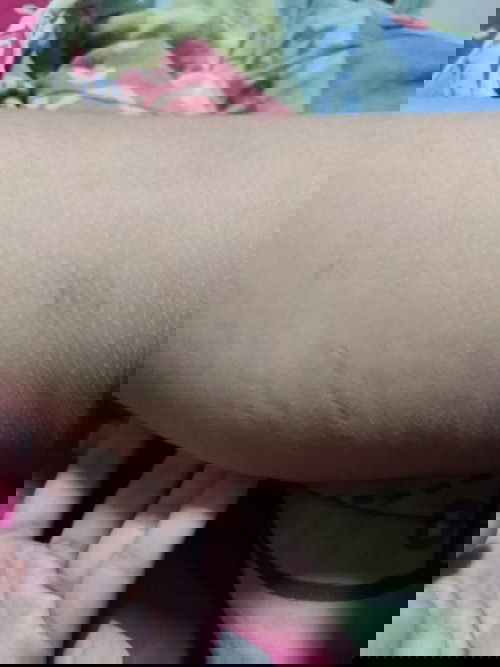 แนะนำครีมลดรอยแตกหน่อยค่า