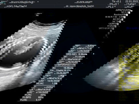 Katanya hidrosepalus